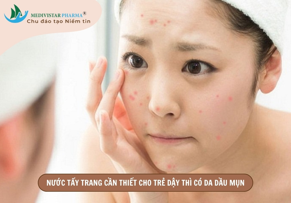 nước tẩy trang cho da dầu mụn tuổi dậy thì